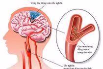 Cách phòng tránh đột quỵ khi trời lạnh