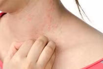 Một số triệu chứng dị ứng thường gặp, cách xử lý