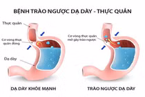 Trào ngược dạ dày có thể biến chứng thành ung thư thực quản