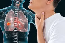Giới trẻ và nguy cơ mắc ung thư phổi và trực tràng sớm