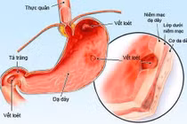 Từ thói quen tưởng vô hại đến nguy cơ xuất huyết tiêu hóa