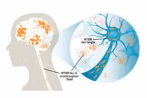 Dấu hiệu ban đầu của Alzheimer dễ bị bỏ qua