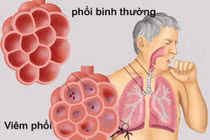 Các biến chứng thầm lặng của viêm phổi nặng, cách phòng ngừa