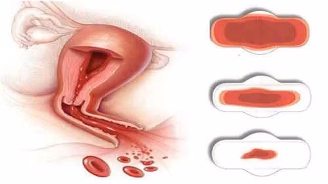 Chảy máu quá nhiều hoặc đau trong kỳ kinh nguyệt có thể là dấu hiệu u xơ tử cung