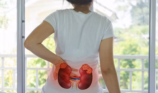 Người bị suy thận độ 3 thường xuất hiện triệu chứng đau thắt lưng - hông Người bị suy thận độ 3 thường xuất hiện triệu chứng đau thắt lưng - hông