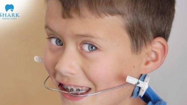 Niềng răng trẻ em là gì? Địa chỉ thực hiện niềng răng trẻ em an toàn