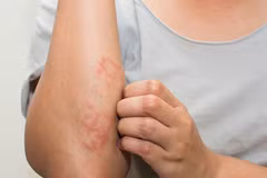 Viêm mao mạch dị ứng, nhận biết đúng để phòng tránh biến chứng