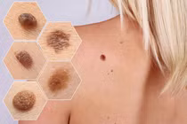 3 bộ phận trên người chuyển thâm đen, cảnh báo ung thư cần đi khám sớm