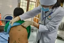 Hà Nội: Ghi nhận khoảng 800 ca mắc thủy đậu từ đầu năm