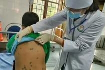 Hà Nội: Ghi nhận khoảng 800 ca mắc thủy đậu từ đầu năm