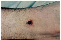 Suy đa tạng do sốt mò: Bệnh nguy hiểm ra sao và dấu hiệu nhận biết?