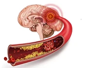 Dọn sạch máu đông trong não để nói không với đột quỵ