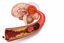 Dọn sạch máu đông trong não để nói không với đột quỵ