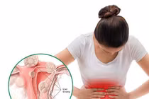 Phẫu thuật u xơ tử cung nếu các triệu chứng bệnh nghiêm trọng