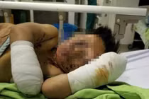 Đắk Lắk: Vật thể lạ phát nổ, bé 8 tuổi bị mất 2 bàn tay