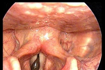 Đỉa bám chặt cổ họng người đàn ông và những vụ khó tin nhưng... có thật