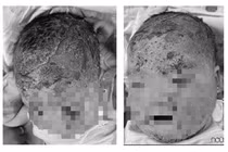 Trẻ 8 tháng tuổi nứt da đầu vì tắm lá: Bác sĩ khuyến cáo gì?