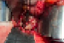 Cô gái 38 tuổi vỡ đại tràng do thụt tháo cà phê thải độc