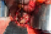 Cô gái 38 tuổi vỡ đại tràng do thụt tháo cà phê thải độc