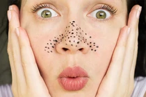 6 cách trị mụn đầu đen cực hiệu quả