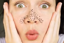 6 cách trị mụn đầu đen cực hiệu quả