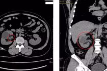 7 năm điều trị nhiễm trùng đường niệu không khỏi bất ngờ phát hiện lao