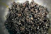 Bác sĩ ngỡ ngàng với hàng nghìn viên sỏi trong túi mật bệnh nhân 