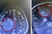 Hai bệnh viện phối hợp cắt khối u não khổng lồ, phức tạp cho người bệnh