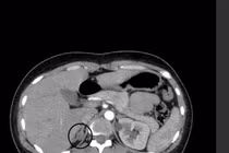Một lần phẫu thuật lấy cả u nang buồng trứng và u tuyến thượng thận