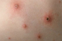 Người lớn mắc thủy đậu dễ suy đa tạng và tử vong