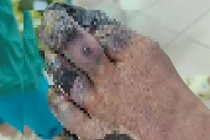 Quấn thuốc đông y trị tê chân, bệnh nhân phải cắt bàn chân vì bỏng