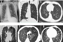 Viêm xoang, viêm phế quản tái diễn cẩn thận hội chứng Kartagener đảo ngược phủ tạng