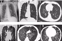 Viêm xoang, viêm phế quản tái diễn cẩn thận hội chứng Kartagener đảo ngược phủ tạng