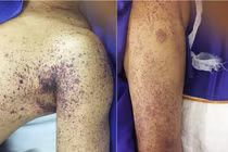 Liên cầu lợn nguy hiểm thế nào nếu không chữa trị kịp thời?