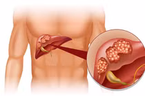 4 triệu chứng cảnh báo ung thư gan cần chú ý