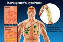 Cách điều trị hội chứng Kartagener gây đảo ngược phủ tạng