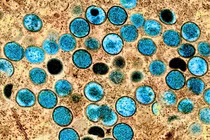 Virus gây bệnh đậu mùa khỉ nguy hiểm sao?