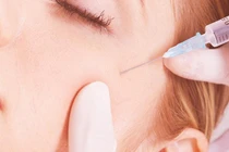 Bác sĩ phân tích rõ nguyên nhân tiêm filler thẩm mỹ lại mù mắt, đột quỵ?