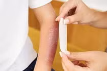 Cách xử trí bỏng đúng để tránh di chứng