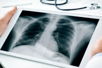 Vụ nhiều công nhân mắc bụi phổi: Biến chứng của bệnh… phòng ngừa như nào?