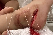 Trẻ 3 tuổi bị dao cứa đứt gân chân do người lớn bất cẩn