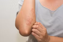 Bệnh sốt mò: Phát hiện muộn có thể dẫn đến tử vong