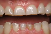 Nhiều tác hại của nghiến răng, không phải ai cũng biết