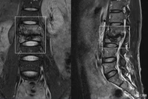 Đau lưng nam thanh niên không ngờ lao cột sống