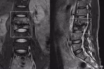 Đau lưng nam thanh niên không ngờ lao cột sống