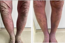 Nhiều người viêm da cơ địa nặng do tự ý điều trị