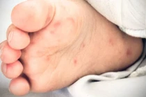 TP.HCM bệnh tay chân miệng tăng, bác sĩ lưu ý nguy cơ tái nhiễm