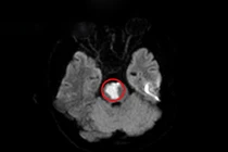 Mới 17 tuổi đã nhồi máu não, cẩn thận khi điều trị tại nhà