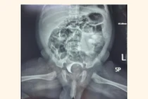 Trẻ vừa sinh có khối sa niệu quản khổng lồ chiếm gần trọn lòng bàng quang