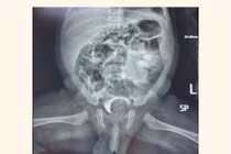 Trẻ vừa sinh có khối sa niệu quản khổng lồ chiếm gần trọn lòng bàng quang